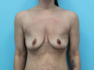 Augmentation & Mastopexy