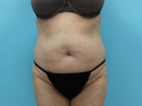 Abdominoplasty