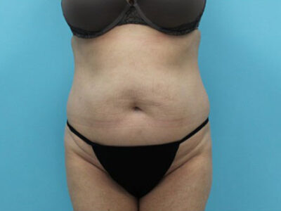 Abdominoplasty