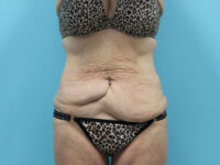 Abdominoplasty
