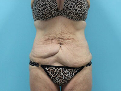 Abdominoplasty