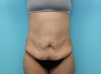Abdominoplasty