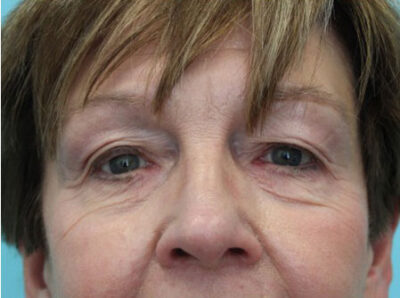 Blepharoplasty