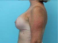Augmentation & Mastopexy