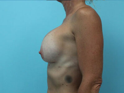 Augmentation & Mastopexy