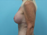 Augmentation & Mastopexy