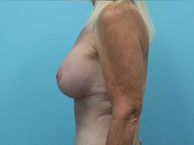 Augmentation & Mastopexy