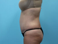 Abdominoplasty