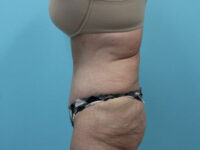 Abdominoplasty
