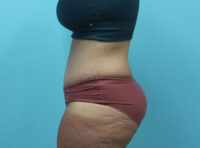 Abdominoplasty