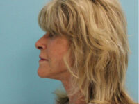 Facelift