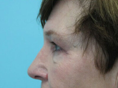 Blepharoplasty