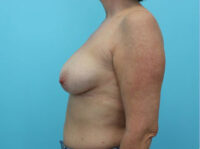 Augmentation & Mastopexy