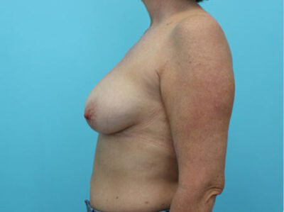 Augmentation & Mastopexy