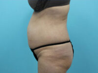 Abdominoplasty