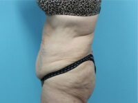 Abdominoplasty