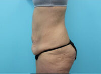 Abdominoplasty