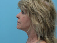 Facelift