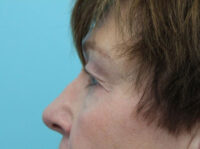 Blepharoplasty