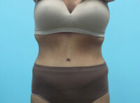 Abdominoplasty