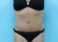 Abdominoplasty