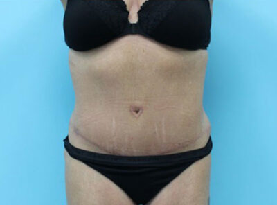 Abdominoplasty