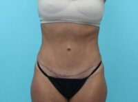 Abdominoplasty