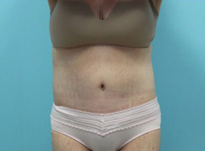 Abdominoplasty