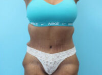 Abdominoplasty