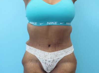 Abdominoplasty