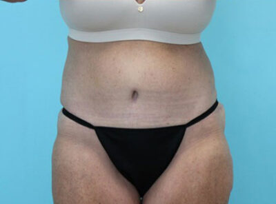 Abdominoplasty