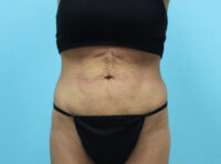 Abdominoplasty