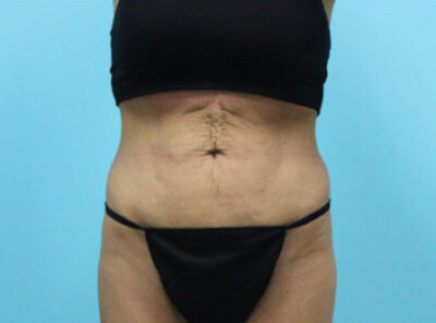 Abdominoplasty