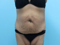 Abdominoplasty