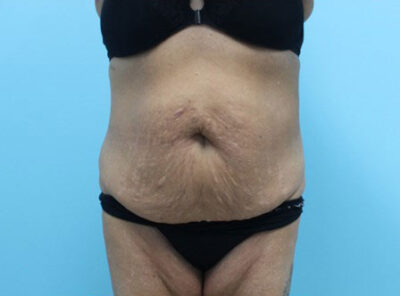 Abdominoplasty