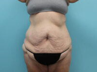 Abdominoplasty