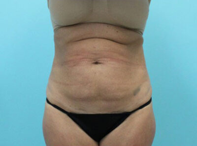 Abdominoplasty