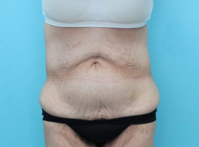 Abdominoplasty