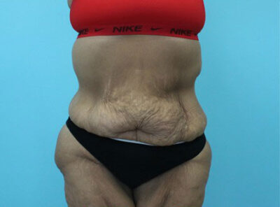 Abdominoplasty