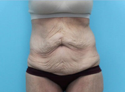 Abdominoplasty