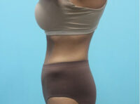 Abdominoplasty
