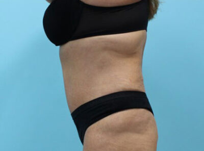Abdominoplasty