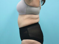 Abdominoplasty