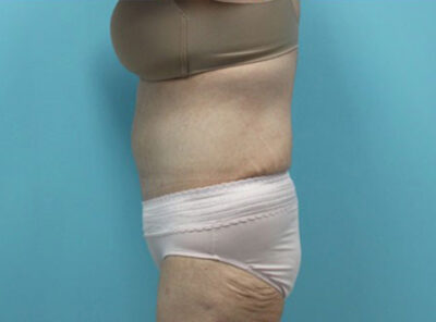 Abdominoplasty