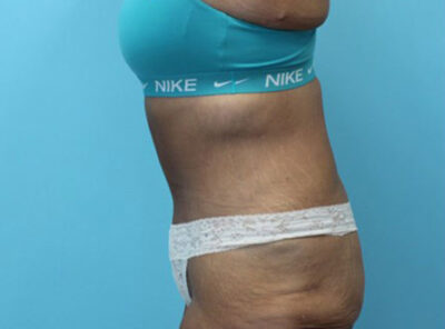 Abdominoplasty