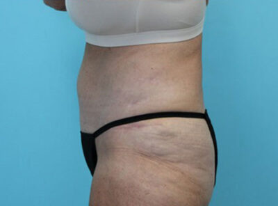 Abdominoplasty