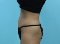 Abdominoplasty