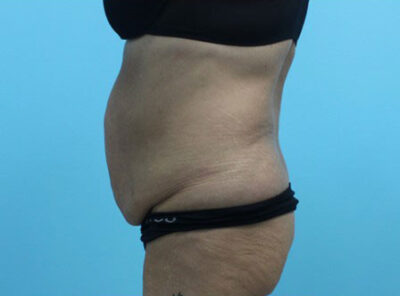 Abdominoplasty
