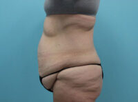Abdominoplasty