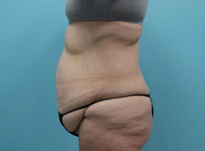Abdominoplasty